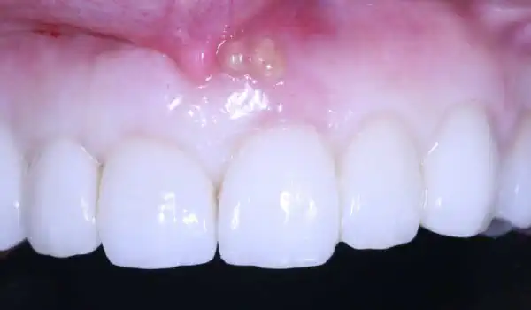 Image for case Treatment of an endo-perio-lesion and soft tissue augmentation with mucoderm®