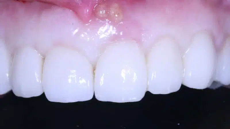 Treatment of an endo-perio-lesion and soft tissue augmentation with mucoderm®