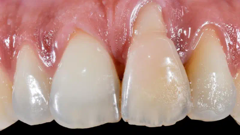 Immediate implant placement with cerabone® and mucoderm®