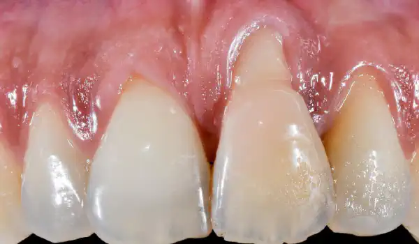 Image for case Immediate implant placement with cerabone® and mucoderm®