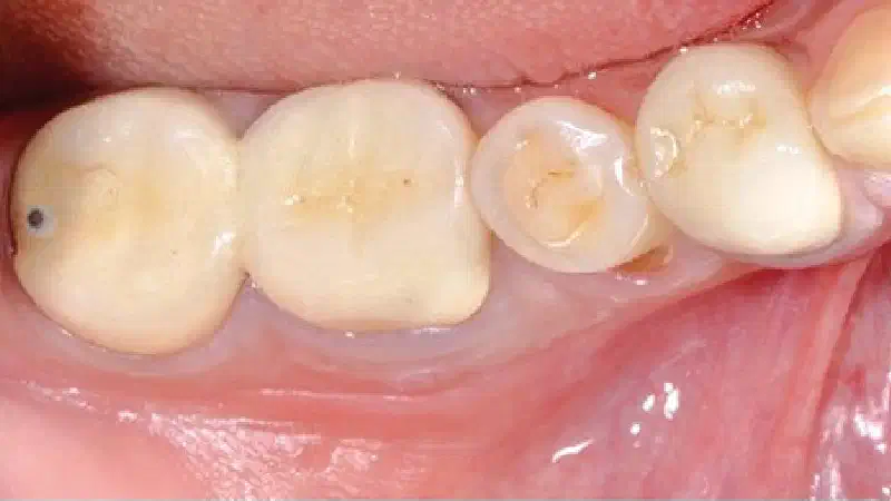 Sealing of an extraction socket with mucoderm®