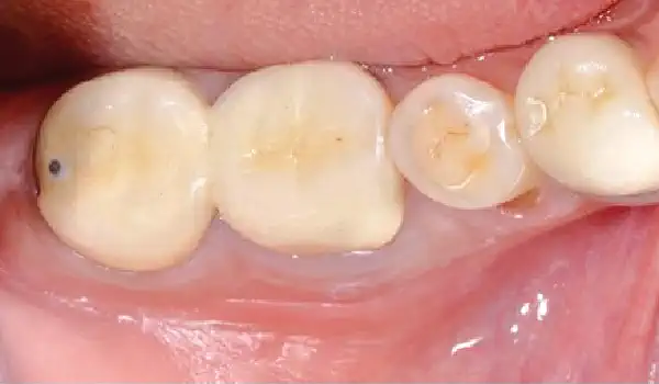 Image for case Sealing of an extraction socket with mucoderm®