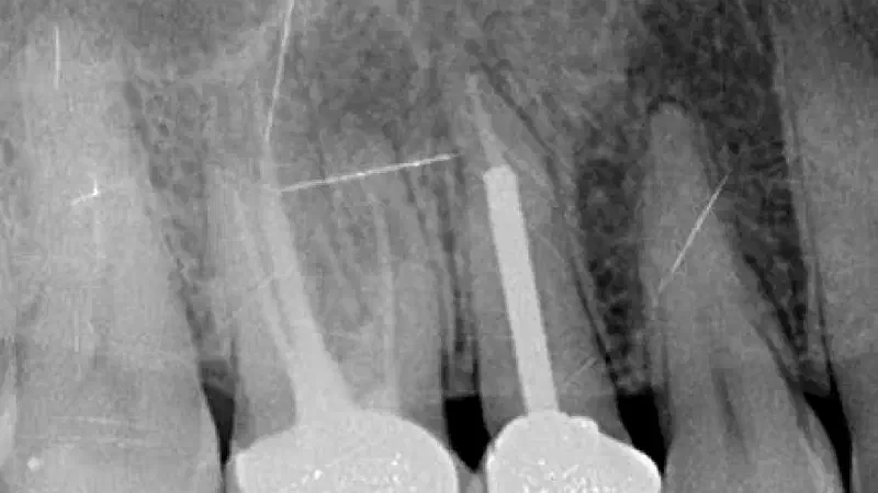 Sealing of a postextraction socket with mucoderm®