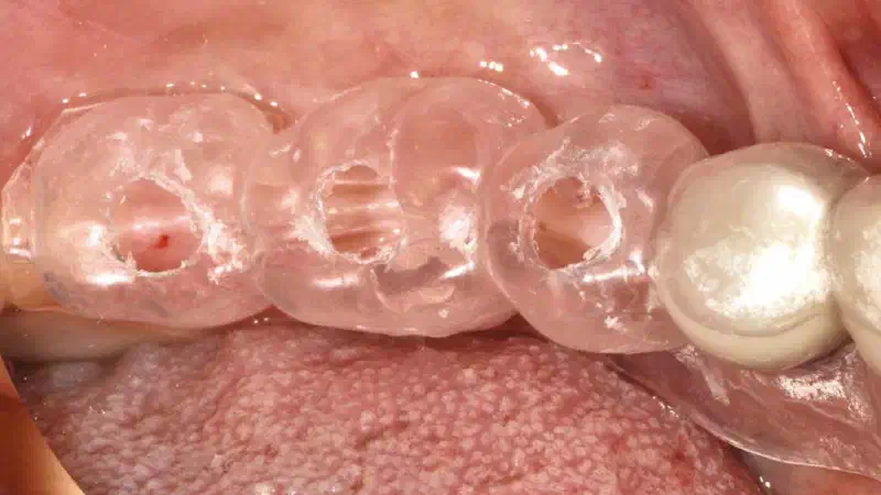 Peri-implant soft tissue thickening with mucoderm®