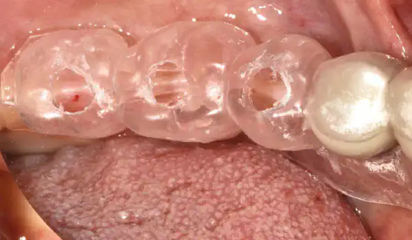 Image for case Peri-implant soft tissue thickening with mucoderm®