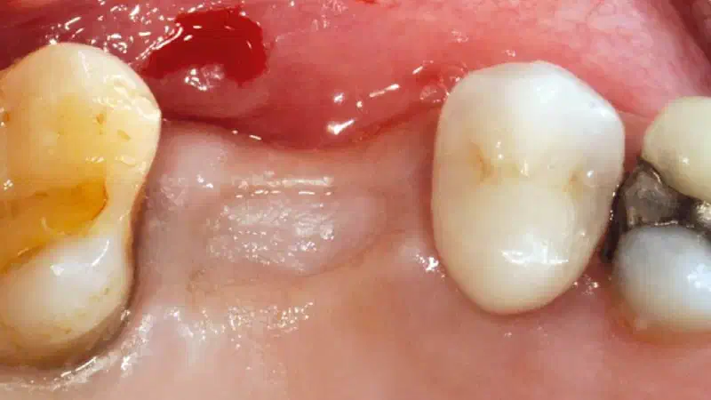 Lateral sinus lift with cerabone® and Jason® membrane – one stage