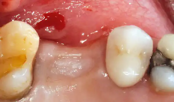 Image for case Lateral sinus lift with cerabone® and Jason® membrane – one stage