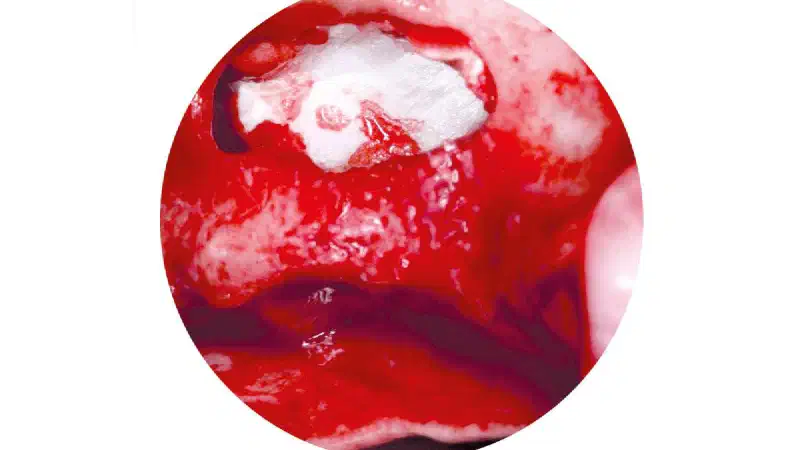 Two-stage sinus lift with maxresorb® & collprotect® membrane