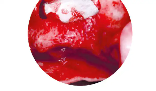 Image for case Two-stage sinus lift with maxresorb® & collprotect® membrane