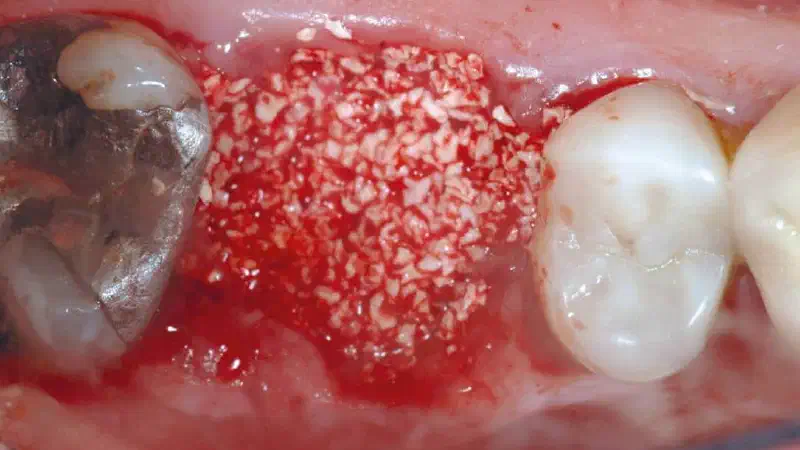 Socket preservation using cerabone® and permamem®