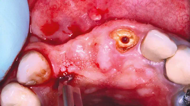 GBR and soft tissue augmentation with cerabone® and mucoderm®