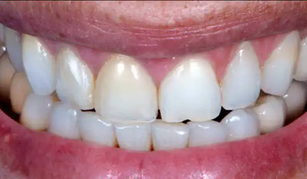 Image for case cerabone® and mucoderm® for immediacy in esthetic zone