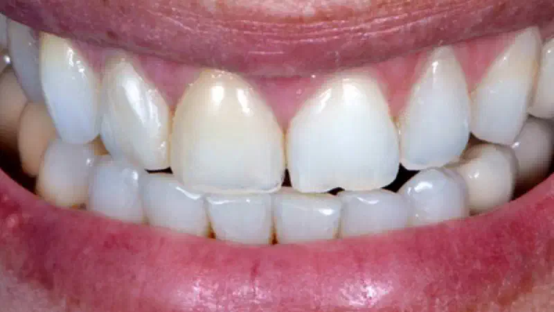 cerabone® and mucoderm® for immediacy in esthetic zone