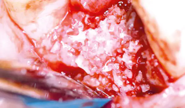 Image for case Ridge preservation using permamem® and maxgraft® granules