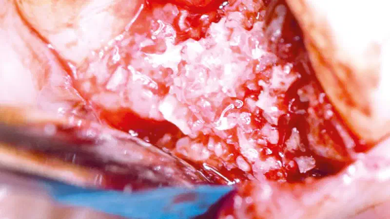 Ridge preservation using permamem® and maxgraft® granules