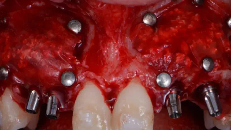 cerabone® and Jason® membrane for immediacy