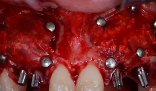Image for case cerabone® and Jason® membrane for immediacy