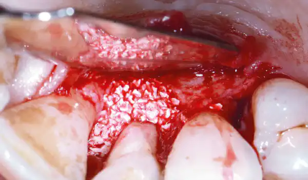Image for case Regeneration of an intrabony defect with cerabone® +HyA and Jason® membrane