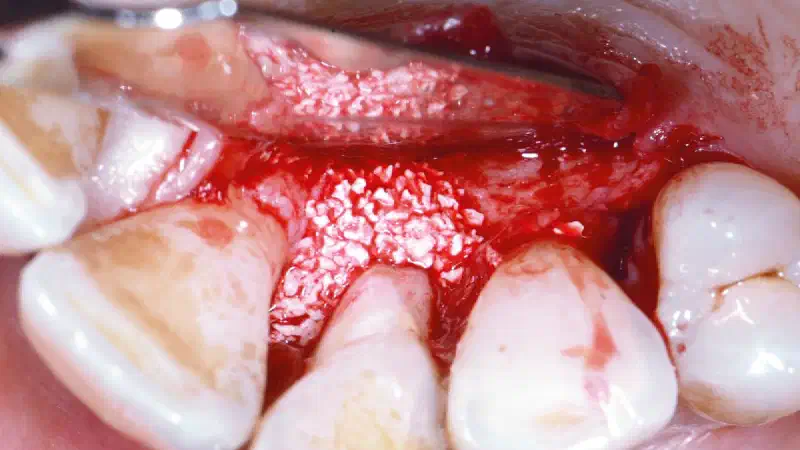 Regeneration of an intrabony defect with cerabone® +HyA and Jason® membrane