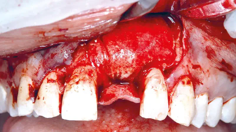cerabone® +HyA for bone augmentation and soft tissue support in the aesthetic zone