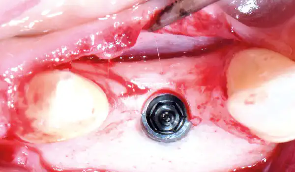 Image for case Peri-implant bone augmentation with cerabone® +HyA and Jason® membrane Viktor Kalenchuk
