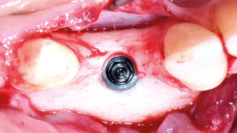 Peri-implant bone augmentation with cerabone® +HyA and Jason® membrane Viktor Kalenchuk