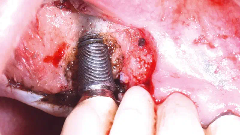 cerabone® +HyA for bone augmentation of a peri-implantitis-affected site