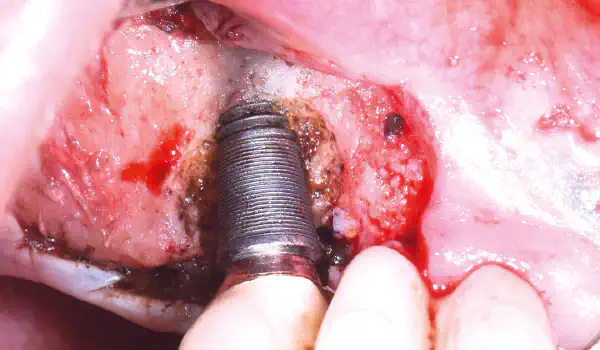 Image for case cerabone® +HyA for bone augmentation of a peri-implantitis-affected site
