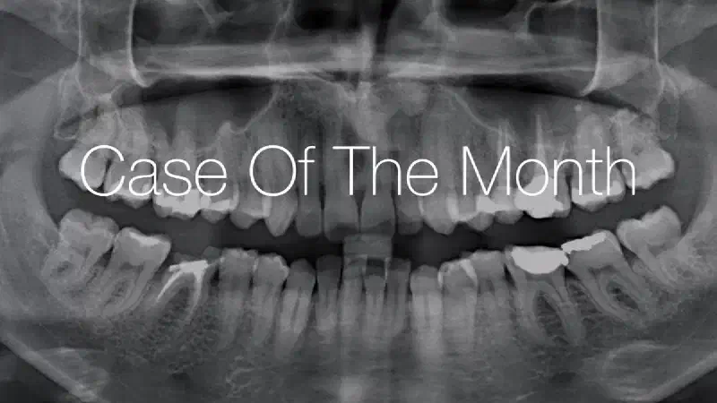 Immediate implant placement and peri-implant bone augmentation with cerabone® +HyA