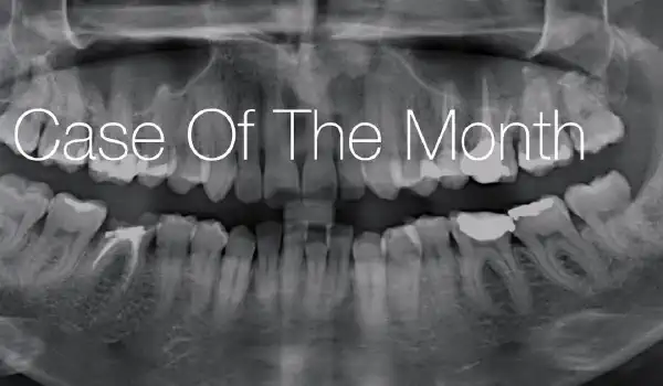 Image for case Immediate implant placement and peri-implant bone augmentation with cerabone® +HyA