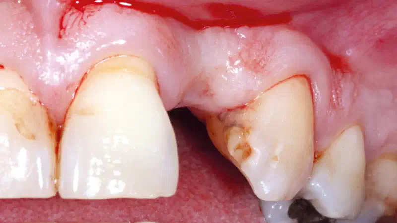 Restoration of single tooth gap in aesthetic zone with maxgraft® bonering