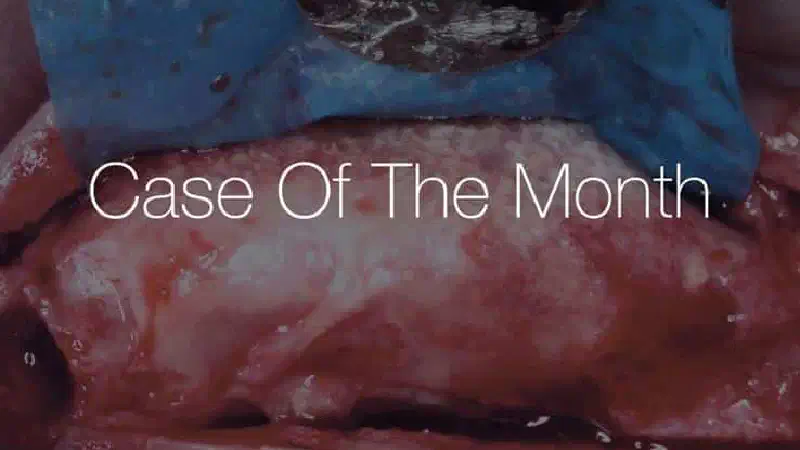 Horizontal ridge augmentation with permamem®, cerabone® and autologous bone chips