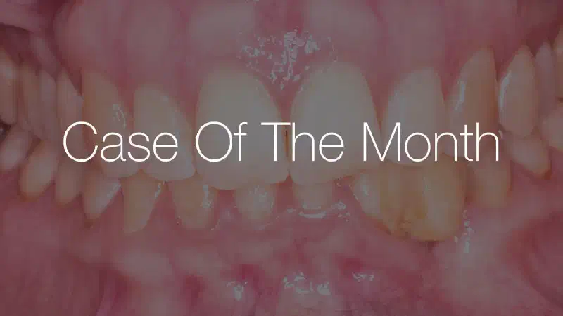 Treatment of vertical bone loss by using cerabone®, autologous bone and Jason® membrane