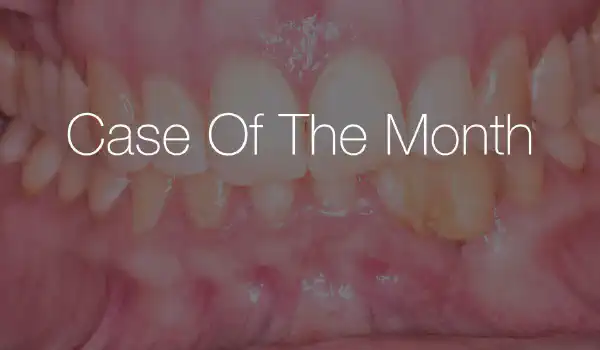 Image for case Treatment of vertical bone loss by using cerabone®, autologous bone and Jason® membrane