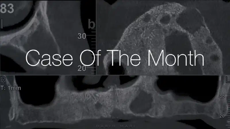 Treatment of a maxillary cyst with cerabone® and Jason® membrane