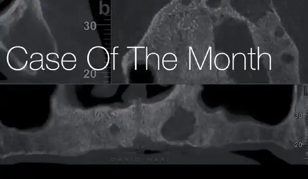 Image for case Treatment of a maxillary cyst with cerabone® and Jason® membrane