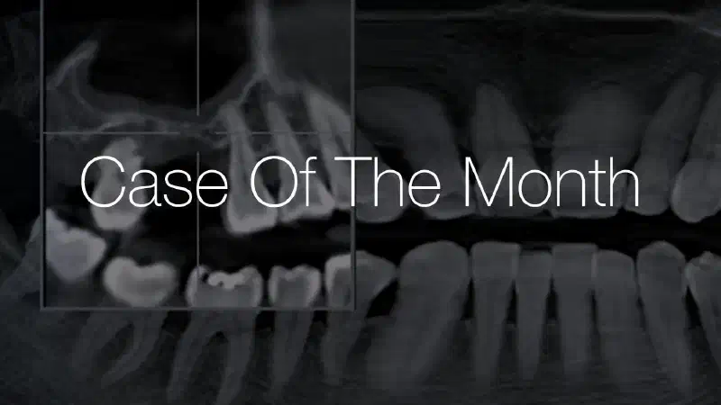 Maxillary sinus augmentation using cerabone® +HyA – A 2-year follow-up