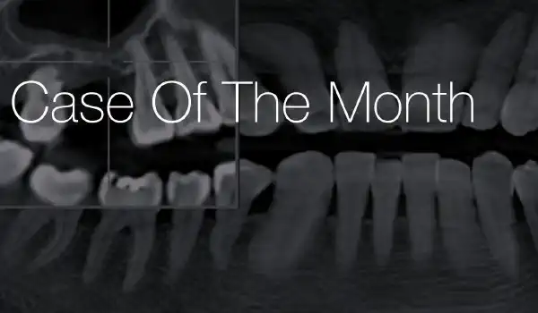Image for case Maxillary sinus augmentation using cerabone® +HyA – A 2-year follow-up