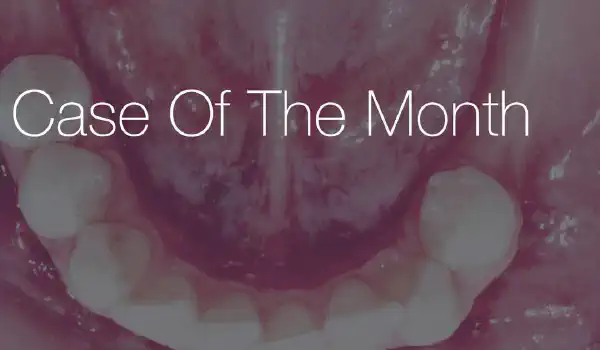 Image for case Ridge augmentation in the mandible with maxgraft® bonebuilder