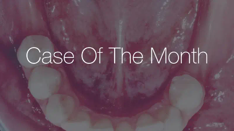 Ridge augmentation in the mandible with maxgraft® bonebuilder