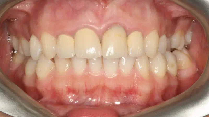 Socket preservation with mucoderm® & maxgraft®