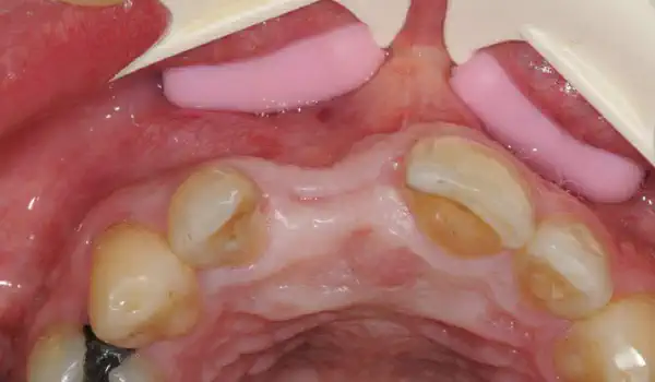 Image for case Restoration of buccal layer in aesthetic zone with maxgraft® bonering