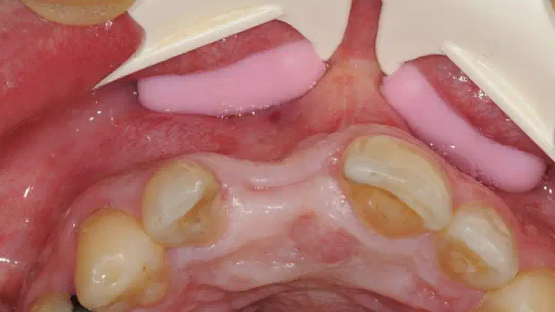 Restoration of buccal layer in aesthetic zone with maxgraft® bonering