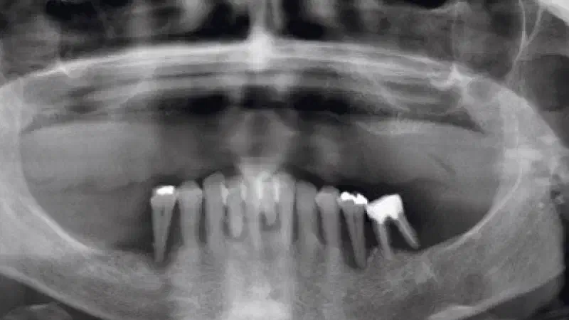 Sinus lift with maxresorb® inject