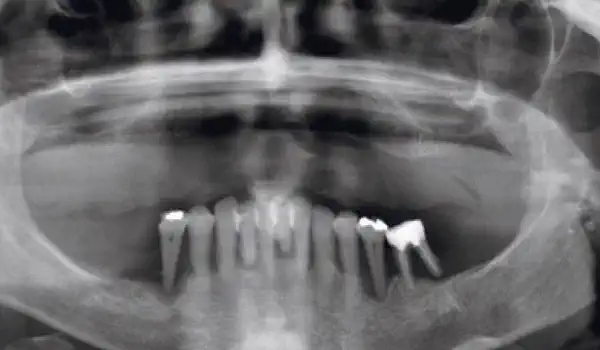 Image for case Sinus lift with maxresorb® inject