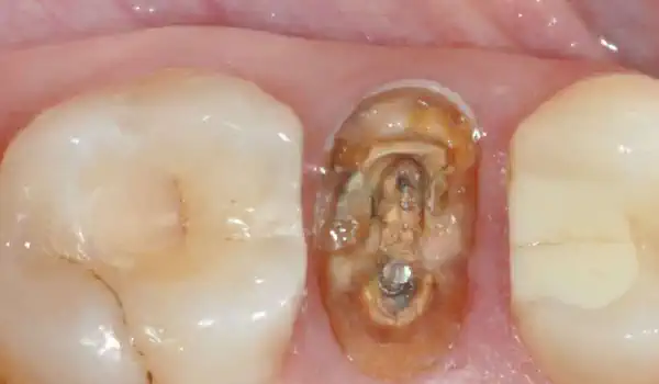 Image for case Filling of extraction socket with collacone®