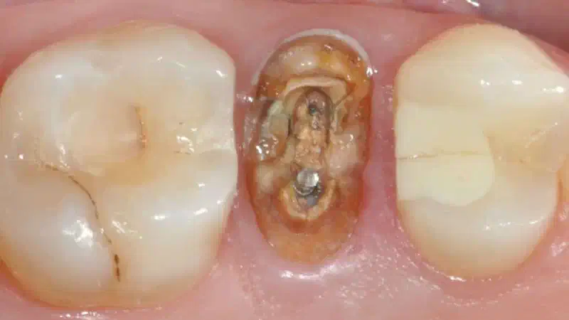 Filling of extraction socket with collacone®