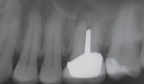 Image for case Internal Sinus lift with maxresorb® inject
