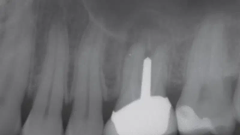 Internal Sinus lift with maxresorb® inject