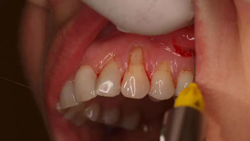 Multiple gingival recessions treated with the modified coronally advanced flap in conjunction with mucoderm®